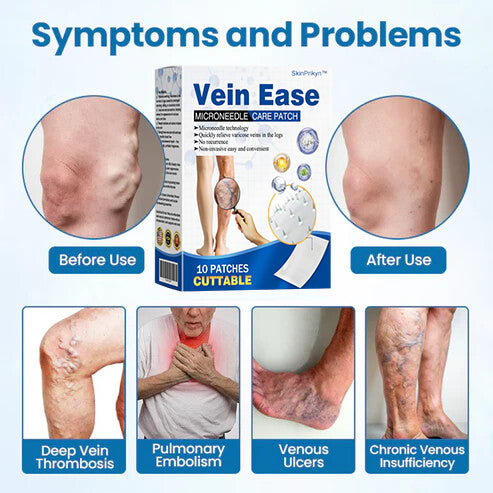 š„Time-Limited Offer -SkinPrikyn⢠Vein Ease Microneedle Care Patch - Cuttable (For Spider Veins, Varicose Veins, Swelling & Leg Fatigue)