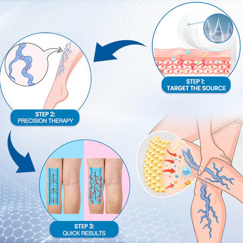 š„Time-Limited Offer -SkinPrikyn⢠Vein Ease Microneedle Care Patch - Cuttable (For Spider Veins, Varicose Veins, Swelling & Leg Fatigue)